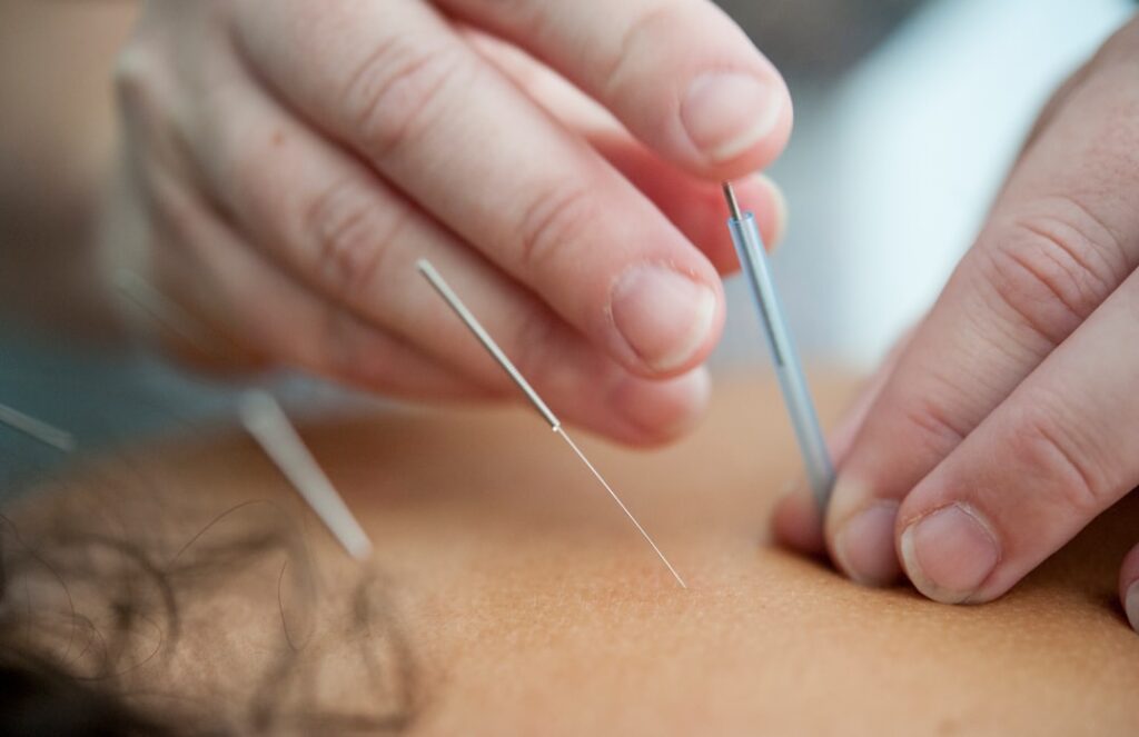 Best Acupuncture & TCM Clinics in Singapore