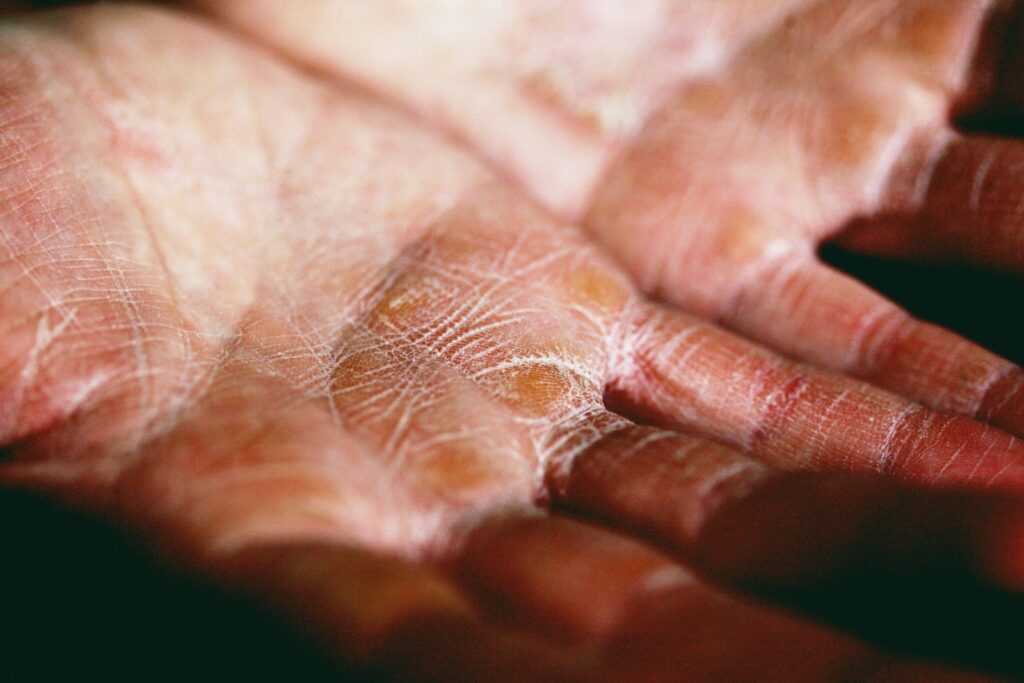 Contact Dermatitis in Singapore — Causes & Treatment