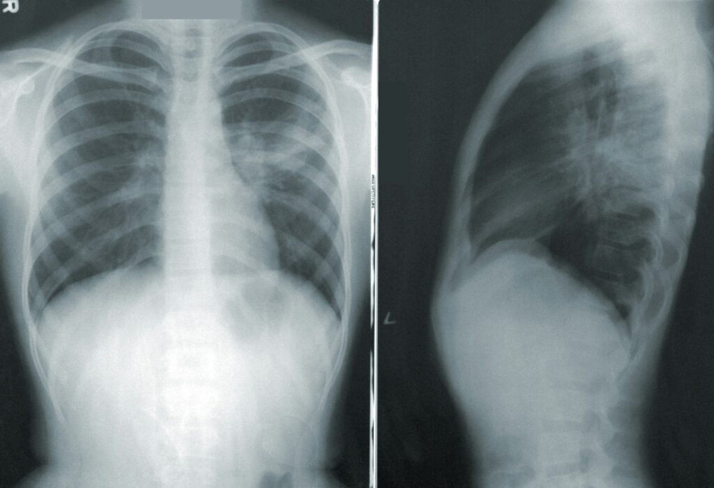 The lungs and breathing
