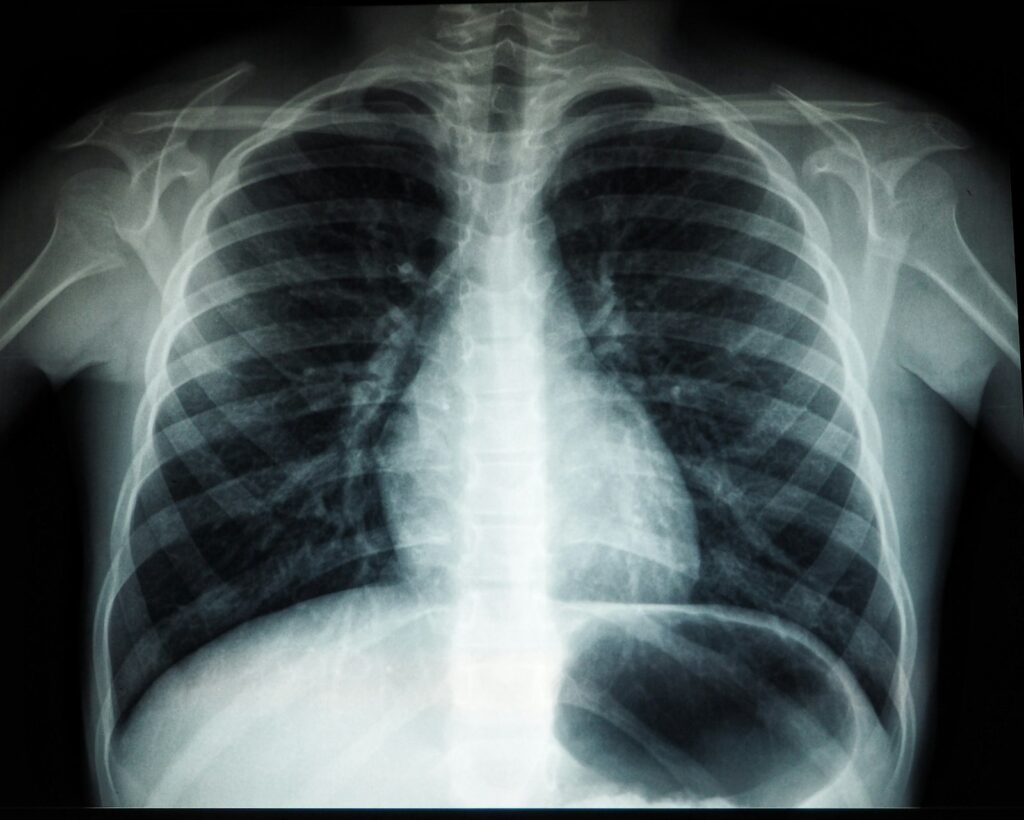 A lung nodule on a CT scan