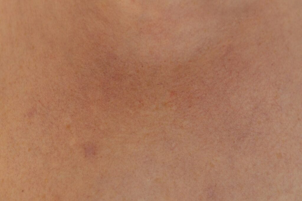 Scar Revision in Singapore — Improving the Look of Scars