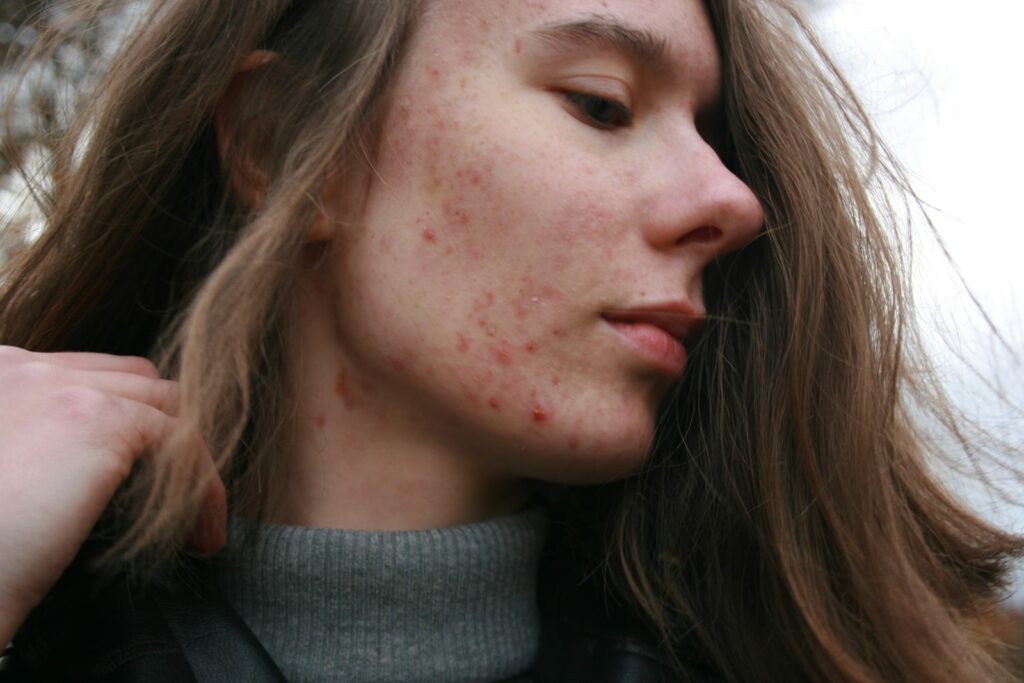 Seborrhoeic Dermatitis in Singapore — Dandruff & Facial Flaking