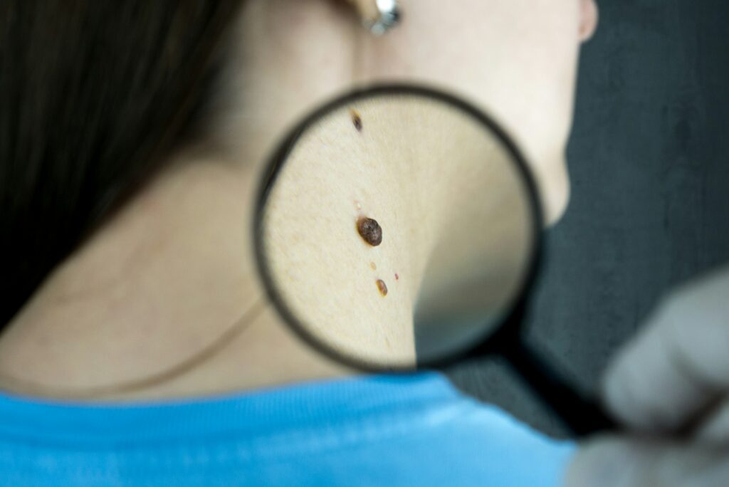 Skin Cancer in Singapore — Types, Warning Signs & Treatment
