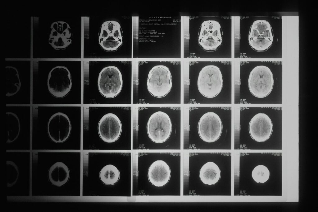 Understanding Parkinson's